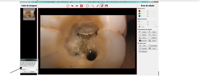 Câmera Intraoral Timex 2H Câmera intraoral Timex Câmera Intraoral Timex 2H Câmera intraoral Timex A câmera intraoral Timex é uma ferramenta poderosa. Com ela é possível exibir em tempo real para o paciente a situação da sua arcada, melhorando o poder de persuasão sobre a necessidade dos tratamentos. Também permite armazenar a situação dos dentes antes do tratamento, comparar com os resultados para melhorar o atendimento e aumentar a percepção de valor sobre o serviço prestado. Além da utilidade prática de facilitar a visualização de pequenos detalhes da arcada diretamente em uma tela de alta definição acoplada a cadeira odontológica.