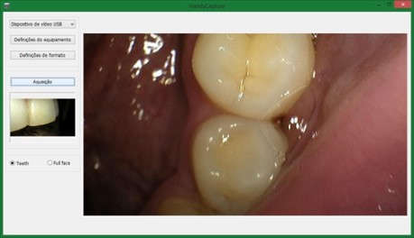 Câmera Intraoral Timex 2H Câmera intraoral Timex Câmera Intraoral Timex 2H Câmera intraoral Timex A câmera intraoral Timex é uma ferramenta poderosa. Com ela é possível exibir em tempo real para o paciente a situação da sua arcada, melhorando o poder de persuasão sobre a necessidade dos tratamentos. Também permite armazenar a situação dos dentes antes do tratamento, comparar com os resultados para melhorar o atendimento e aumentar a percepção de valor sobre o serviço prestado. Além da utilidade prática de facilitar a visualização de pequenos detalhes da arcada diretamente em uma tela de alta definição acoplada a cadeira odontológica.