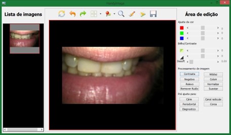Câmera Intraoral Timex 2H Câmera intraoral Timex Câmera Intraoral Timex 2H Câmera intraoral Timex A câmera intraoral Timex é uma ferramenta poderosa. Com ela é possível exibir em tempo real para o paciente a situação da sua arcada, melhorando o poder de persuasão sobre a necessidade dos tratamentos. Também permite armazenar a situação dos dentes antes do tratamento, comparar com os resultados para melhorar o atendimento e aumentar a percepção de valor sobre o serviço prestado. Além da utilidade prática de facilitar a visualização de pequenos detalhes da arcada diretamente em uma tela de alta definição acoplada a cadeira odontológica.