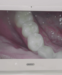 Câmera Intraoral Timex 1H Câmera intraoral Timex A câmera intraoral Timex 1H é uma ferramenta poderosa. Com ela é possível exibir em tempo real para o paciente a situação da sua arcada, melhorando o poder de persuasão sobre a necessidade dos tratamentos. Também permite armazenar a situação dos dentes antes do tratamento e comparar com os resultados, para melhorar o atendimento e aumentar a percepção de valor sobre o serviço prestado. Além da utilidade prática de facilitar a visualização de pequenos detalhes da arcada diretamente em uma tela de alta definição acoplada a cadeira odontológica.