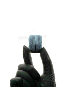 Filme Radiográfico Odontológico Autorrevelável Gnatus Filme autorrevelável gnatus Filme Radiográfico Odontológico Autorrevelável Gnatus Filme autorrevelável gnatus Caixa de filme radiográfico intraoral autorrevelador Gnatus (30,5 × 40,5 mm), pronta para uso sem câmara escura: revela e fixa em 50 segundos com menor exposição ao RX e alta definição. Material atóxico e não poluente, sem chumbo, cádmio ou tiossulfatos, com durabilidade de até 10 anos. Design ergonômico para posicionamento confortável (anteriores e posteriores) e compatibilidade com paralelismo e vídeo-radiografia digital.