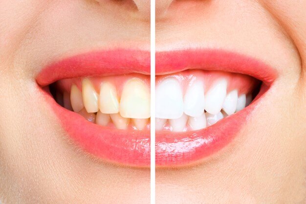 Clareamento dental, entenda Clareamento-dental-entenda