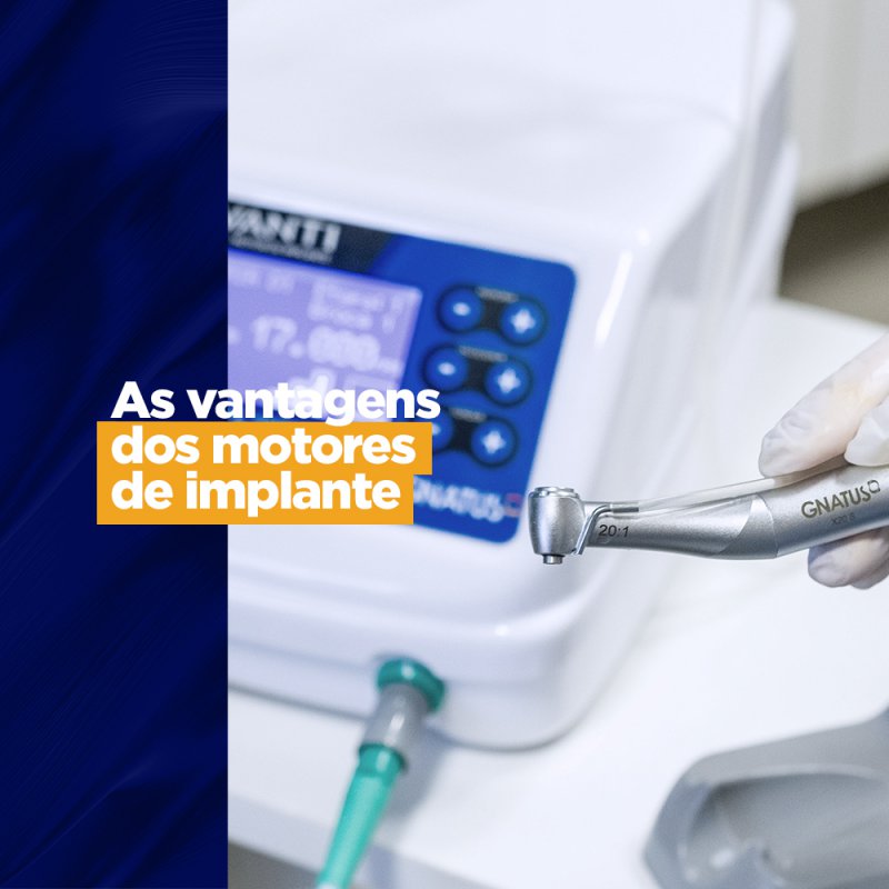 As vantagens dos motores de implante Gnatus As vantagens dos motores de implante Gnatus Um instrumento versátil que pode ser encontrado em vários modelos no mercado, por isso, é de extrema importância que você saiba exatamente o que irá comprar na hora de escolher seu motor de implante.