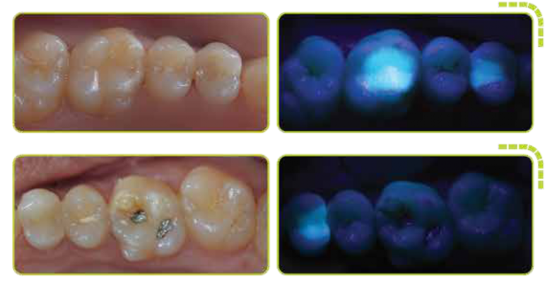 A revolução da alta rotação está no mercado! alta rotação odontológico A revolução da alta rotação está no mercado! alta rotação odontológico Unindo toda a sua experiência com as melhores peças de mão no mercado e a tecnologia que sempre buscamos desenvolver, foi assim que surgiu a nova Ax3. Estilo ergonômico que permite o alto desempenho na hora da remoção de cáries, restaurações e odonto secção, como auxílio na extração de dentes.