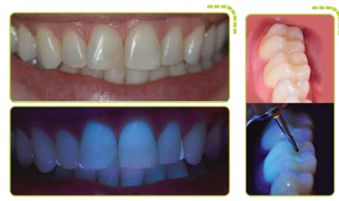 A revolução da alta rotação está no mercado! alta rotação odontológico A revolução da alta rotação está no mercado! alta rotação odontológico Unindo toda a sua experiência com as melhores peças de mão no mercado e a tecnologia que sempre buscamos desenvolver, foi assim que surgiu a nova Ax3. Estilo ergonômico que permite o alto desempenho na hora da remoção de cáries, restaurações e odonto secção, como auxílio na extração de dentes.