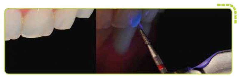 A revolução da alta rotação está no mercado! alta rotação odontológico A revolução da alta rotação está no mercado! alta rotação odontológico Unindo toda a sua experiência com as melhores peças de mão no mercado e a tecnologia que sempre buscamos desenvolver, foi assim que surgiu a nova Ax3. Estilo ergonômico que permite o alto desempenho na hora da remoção de cáries, restaurações e odonto secção, como auxílio na extração de dentes.