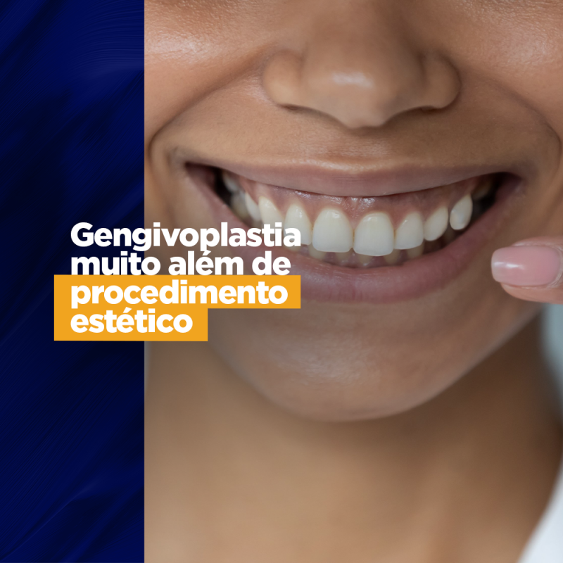 Gengivoplastia muito além de procedimento estético Com o propósito de melhor a estética do sorriso, deixando-o mais harmonioso, e para melhorar a saúde bucal dos pacientes, com a retirada de gengivas grandes e espaçosas a gengivoplastia é um procedimento que está sendo muito procurado pelos pacientes e indicados pelos melhores profissionais.