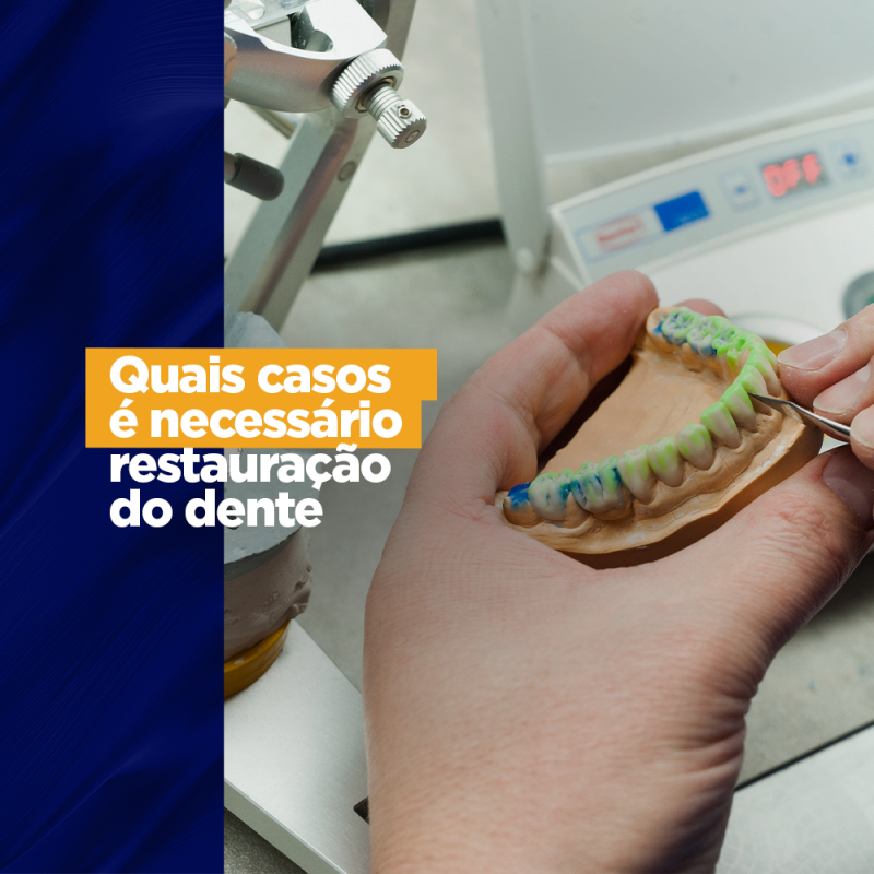 Quais casos é necessário restauração do dente Quais casos é necessário restauração do dente Fazemos ferramentas para prover sorriso, pois, acreditamos na importância que ele tem. Afinal ele é o grande sinal de que coisas boas estão acontecendo, também é considerado uma forma de demonstrar carinho. Com tudo isso você já imaginou não ter um belo sorriso para tudo isso?