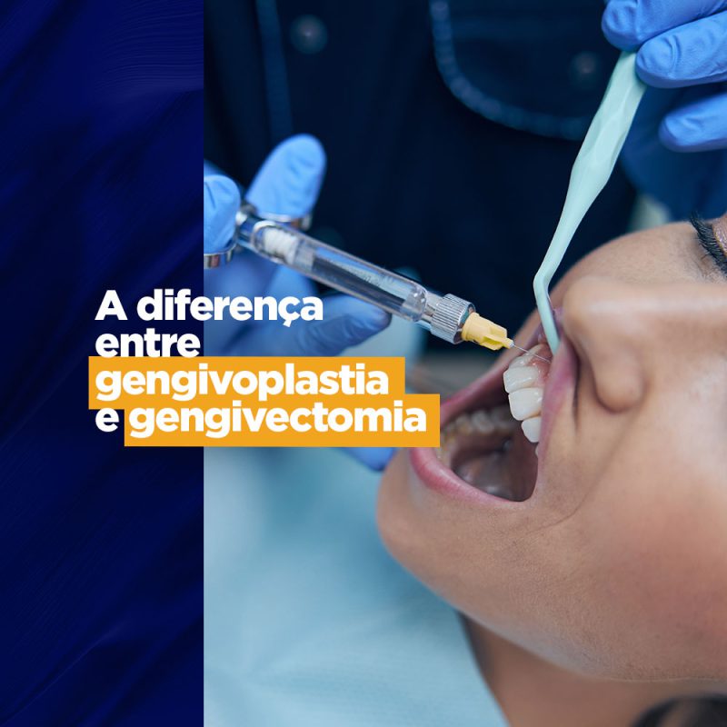 Cirurgias gengivais: a diferença entre gengivoplastia e gengivectomia radiografias cirurgias gengivais