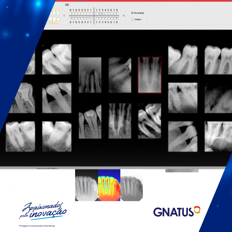 Diagnóstico de Raio X sem Riscos alta rotação odontológico A palavra biosseguraça está muito ligada à odontologia e nos equipamentos Gnatus fazemos o melhor dos dois mundos sempre. Mas...nesse equipamento aqui, fomos além.