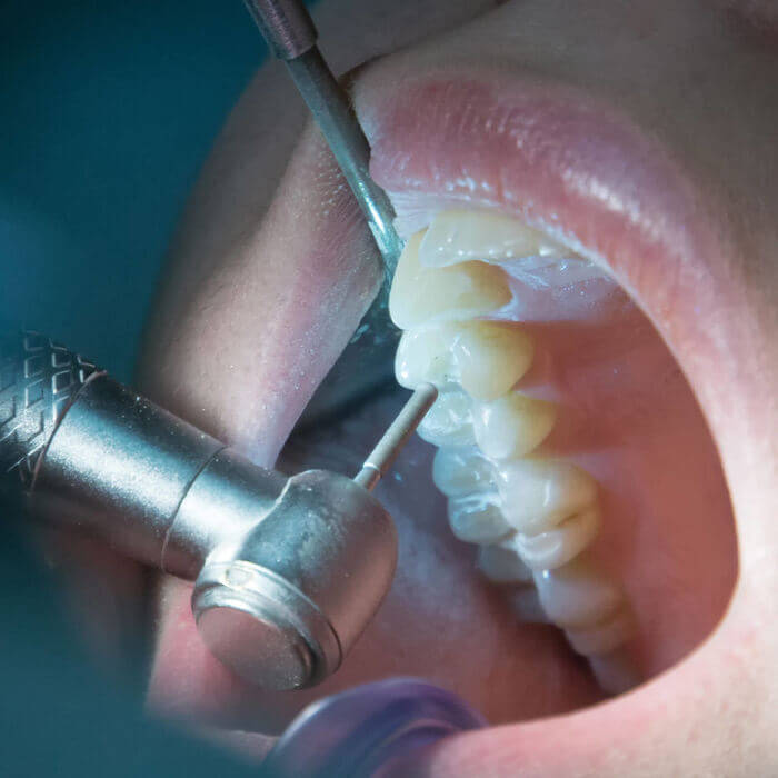 Usos do ultrassom na Endodontia