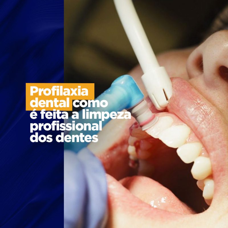 Profilaxia dental como é feita a limpeza profissional dos dentes CIOCE Profilaxia dental como é feita a limpeza profissional dos dentes CIOCE A profilaxia dental é um procedimento importante para manter a saúde bucal em dia e evitar problemas como cáries, gengivite e periodontite. Também conhecida como limpeza profissional, a profilaxia é realizada pelo dentista, e consiste em uma série de etapas que visam remover o tártaro, a placa bacteriana e as manchas dos dentes.